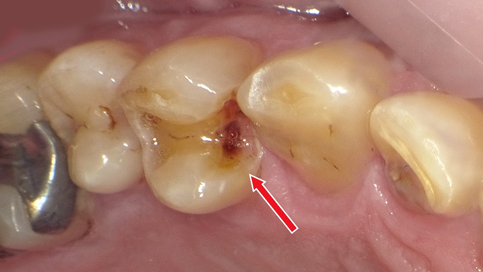 銀歯インレーの下で進行した“隠れ虫歯”
放置による脱離と二次カリエスの危険性