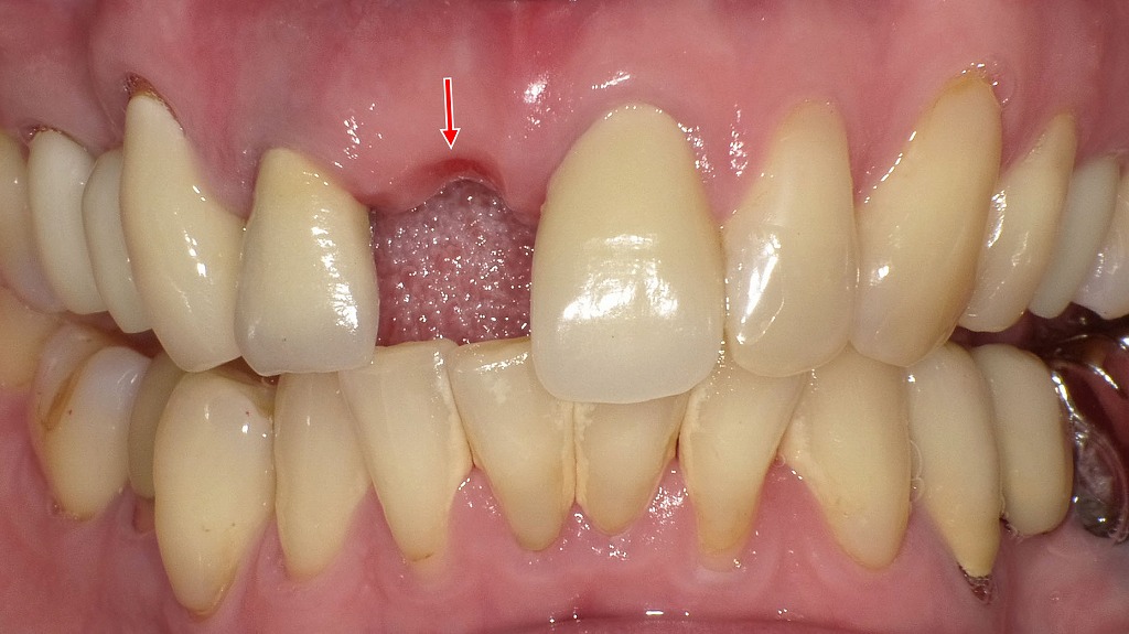 上顎右上１番欠損による審美・機能低下の状態（ノンクラスプデンチャー装着前）