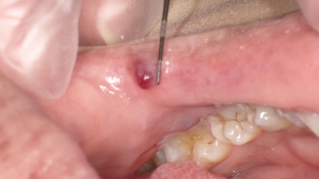 唇にできた血豆