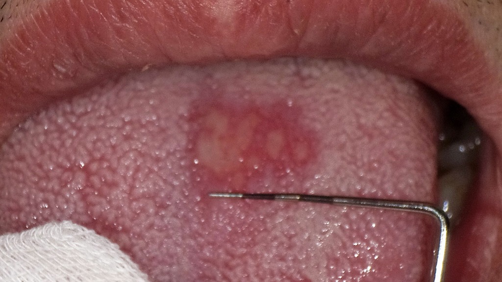 舌にできたアフタ性口内炎