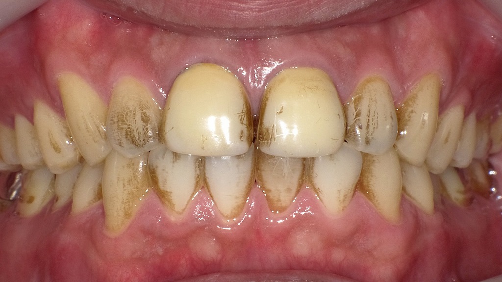歯磨き後に飲んでいいもの・避けたいもの｜着色リスクに注意