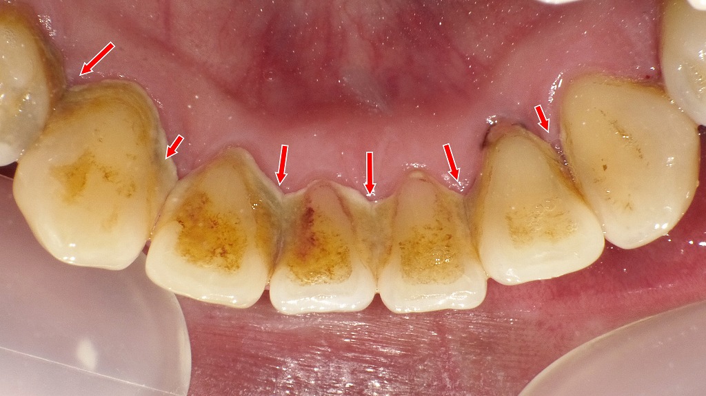 歯周病になりやすい人の特徴｜下顎舌側に歯石がたまりやすい状態