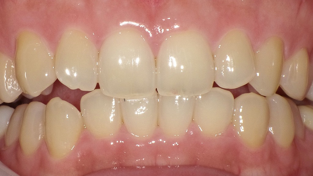 エナメル質は「透明感」をつくる最外層