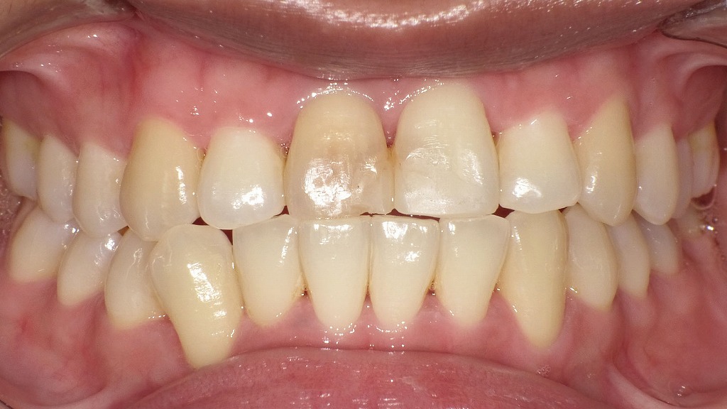 歯周病治療後の引き締まった健康な歯ぐき