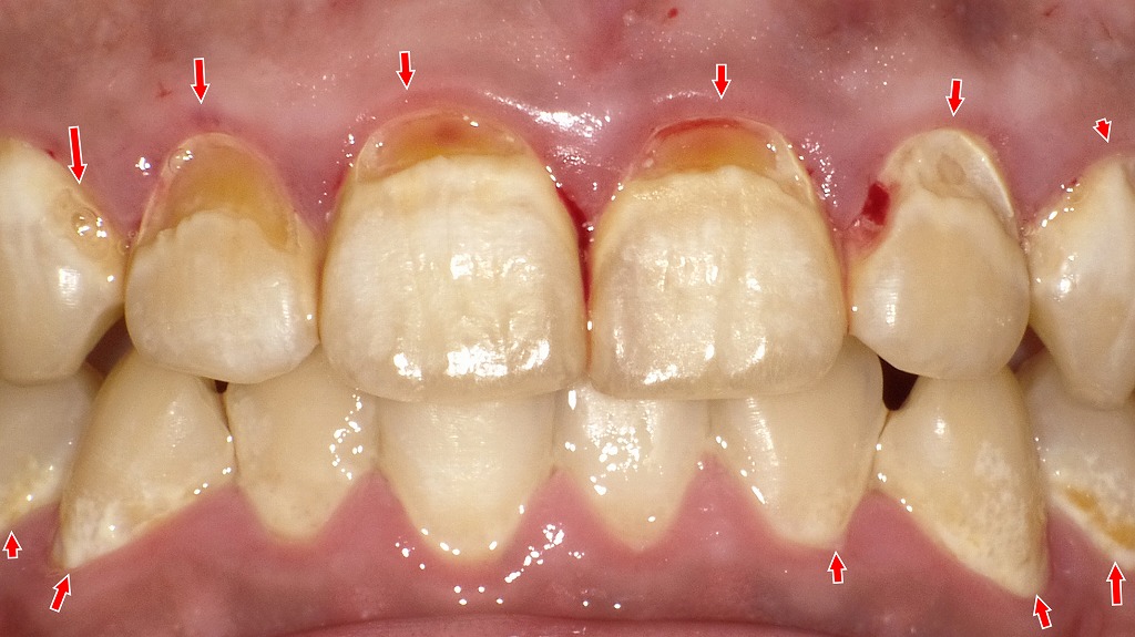 ペットボトル症候群が引き起こす多発性虫歯のリスク