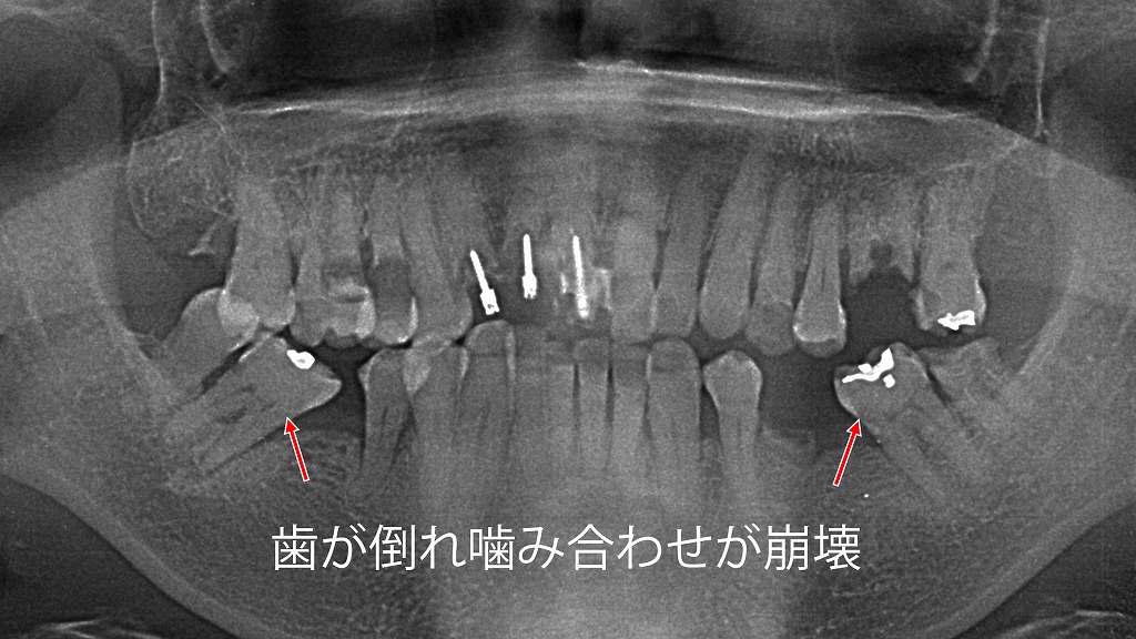 奥歯の虫歯を放置すると起こる「歯の傾斜」と噛み合わせの崩壊