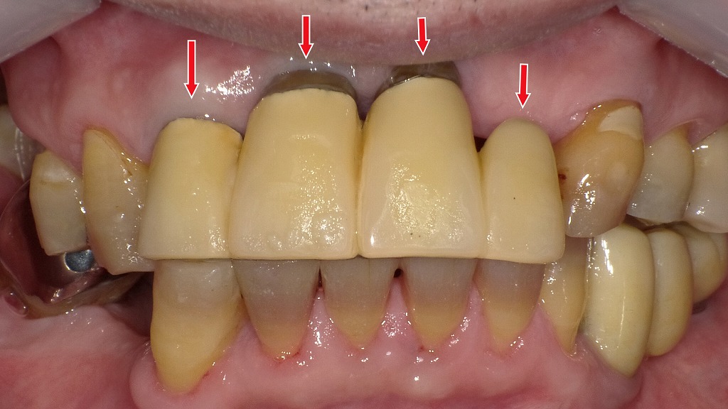 経年劣化した硬質レジン前装冠。歯ぐき付近の変色や黒い境界が目立ち、審美性が低下しています