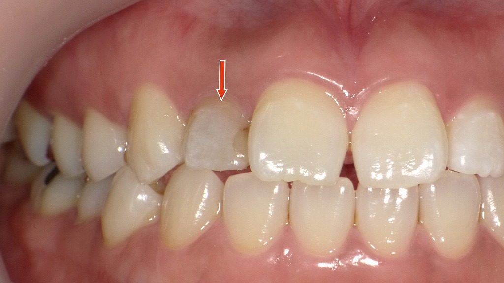 1枚目：歯髄壊死による前歯の変色