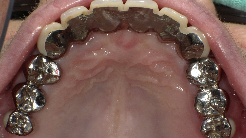 保険の銀歯が身体に影響？金属アレルギーのリスクに注意