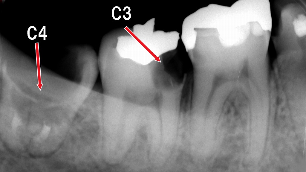 歯が浮くように感じる原因は?──C3虫歯による歯髄炎
