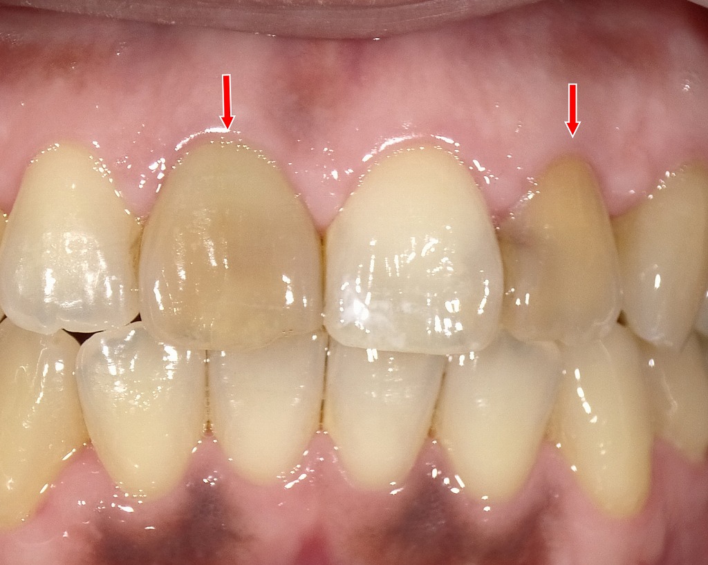 赤矢印の前歯は、周囲よりも濃い黄色に見えています。これは神経を失った歯(失活歯)に起こりやすい内部からの変色で、時間とともに透明感が失われて黄ばみが進行します。