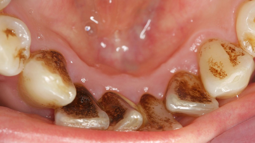 喫煙習慣とタバコのヤニ