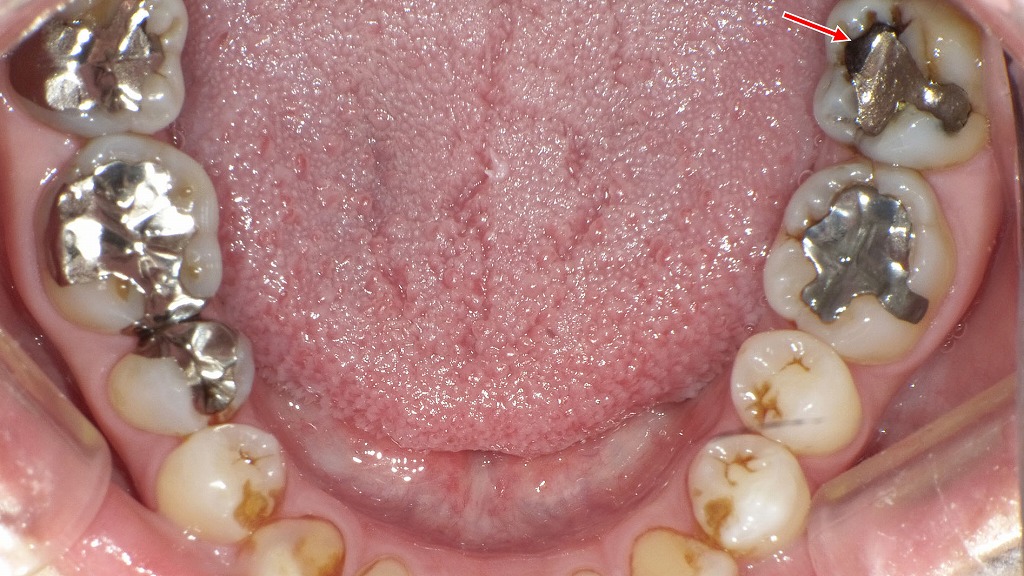 銀歯の一部が欠けたことによる二次カリエス
