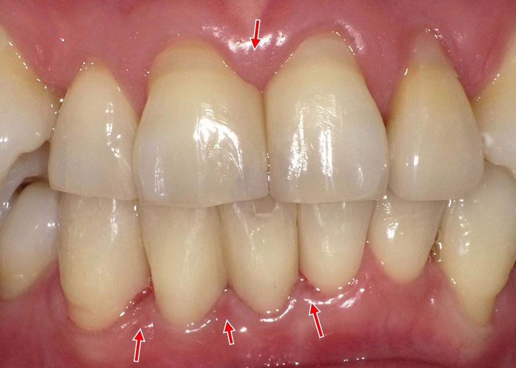 妊娠性歯肉炎で歯茎の腫れや出血