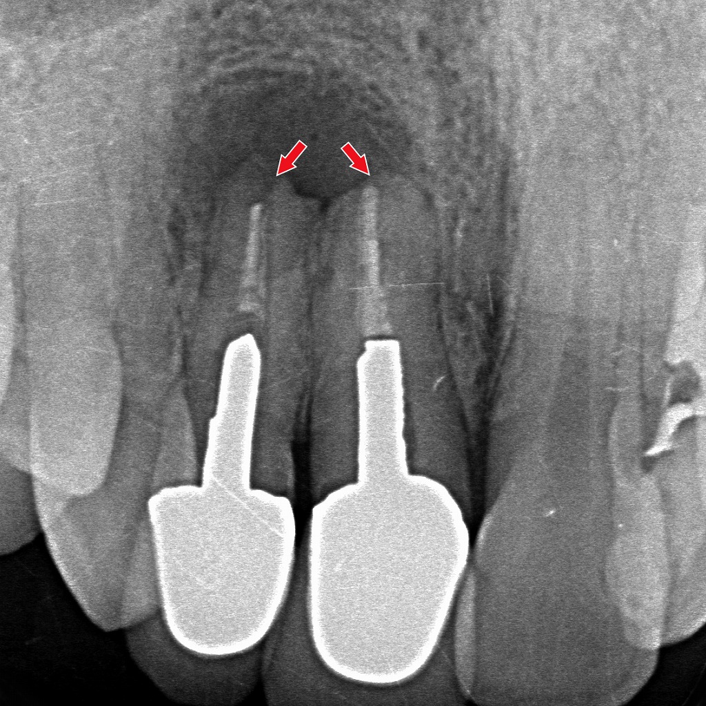 過蓋咬合が招く前歯の歯根吸収リスク