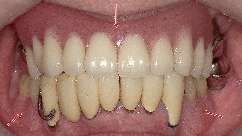 保険のクラスプ義歯でも自然な噛み合わせへ｜入れ歯が上手な歯医者の治療例