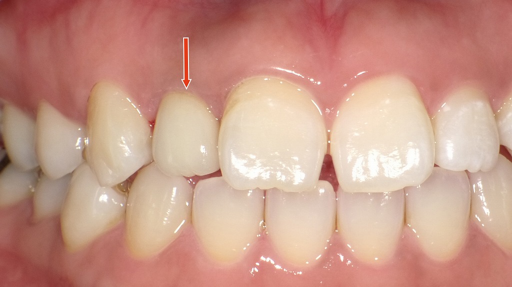 2枚目：オールセラミックによる自然な色調の回復