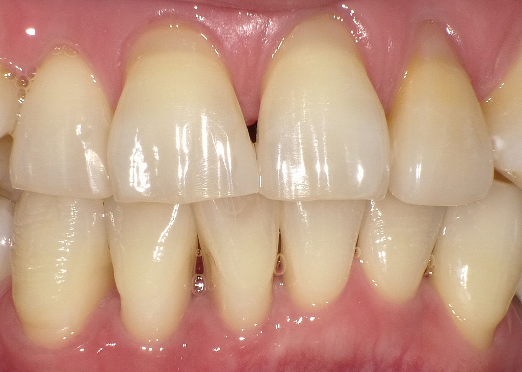 妊娠性歯肉炎|歯石除去(クリーニング)後の口腔内状態