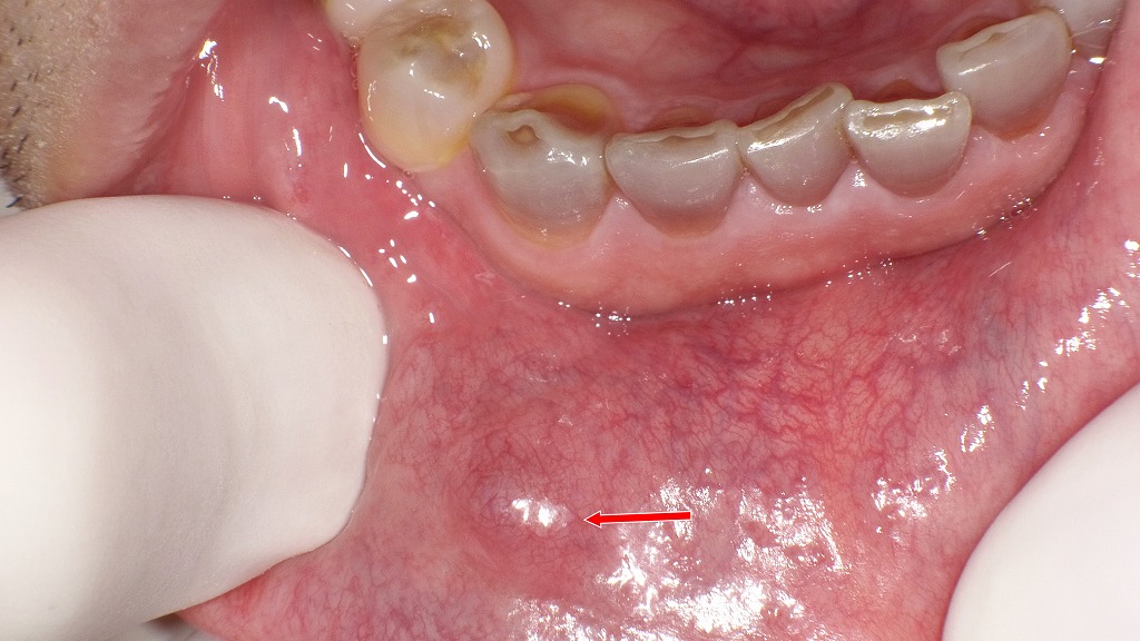 唇に出来た粘液嚢胞