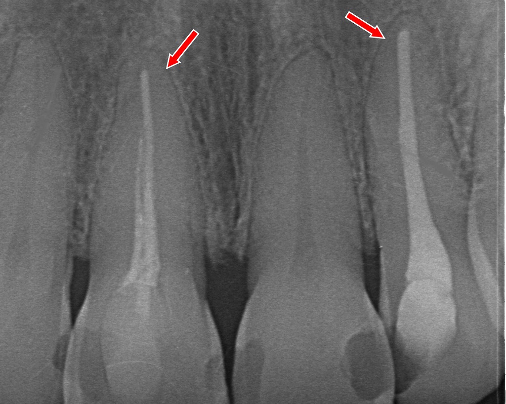 レントゲンで見る「神経を取った歯」──赤矢印の歯には、根の中に白い根管充填材がしっかり入っています。神経を取った歯の特徴で、内部の代謝が止まることで水分が減り、歯が暗く黄ばんで見える原因になります。