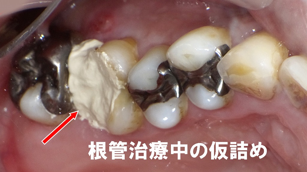 根管治療中の仮詰め