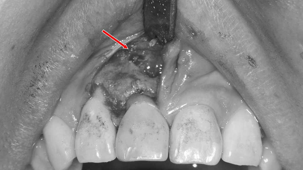 赤矢印は、歯根端切除術で露出した根尖部と感染組織を示しています。粘膜剥離後、骨開削によって根尖病変に到達した術中所見です。