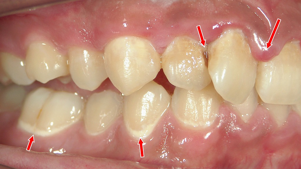 清涼飲料の常飲でプラークが増え、前歯に脱灰と歯肉炎が進行した状態です。