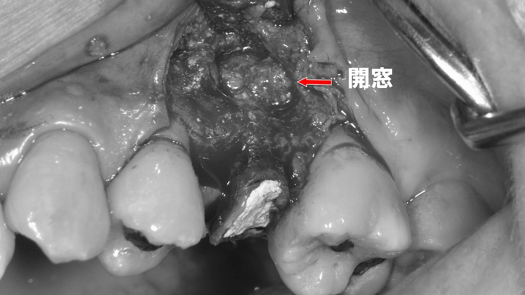 歯根端切除術：病変部へアクセスするための歯槽骨開窓