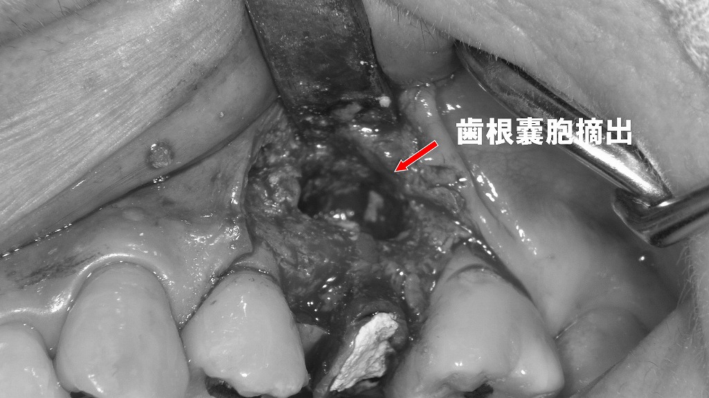 歯根端切除術：歯根嚢胞の摘出ステップ