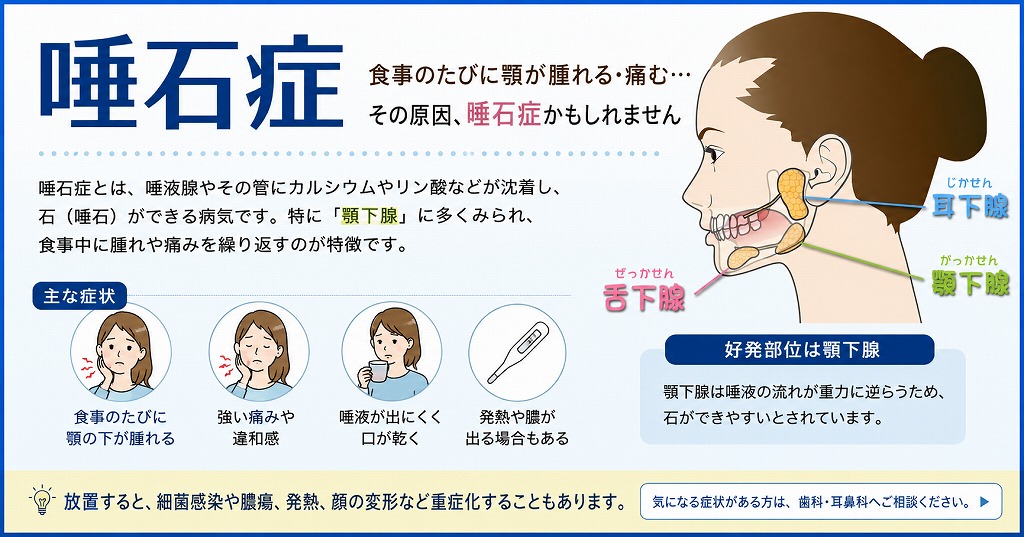 唾石症とは？