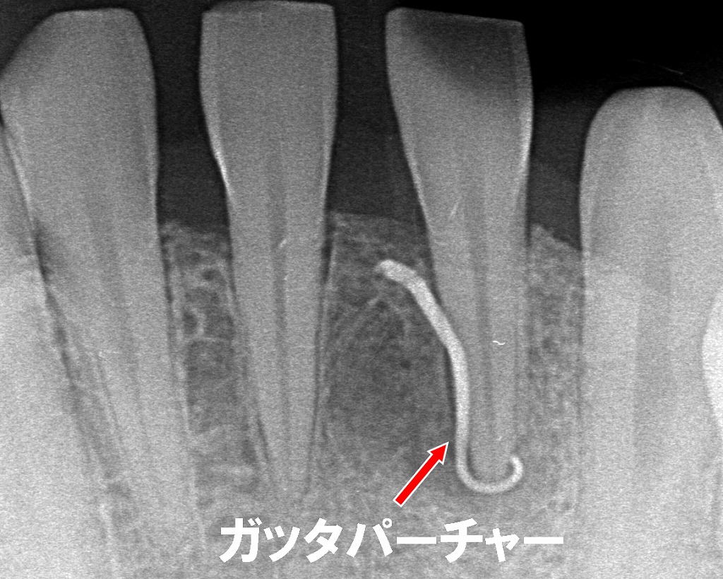 フィステルから挿入したガッタパーチャが左下1番の根尖に到達。
膿の原因となっている感染源を正確に示しています。