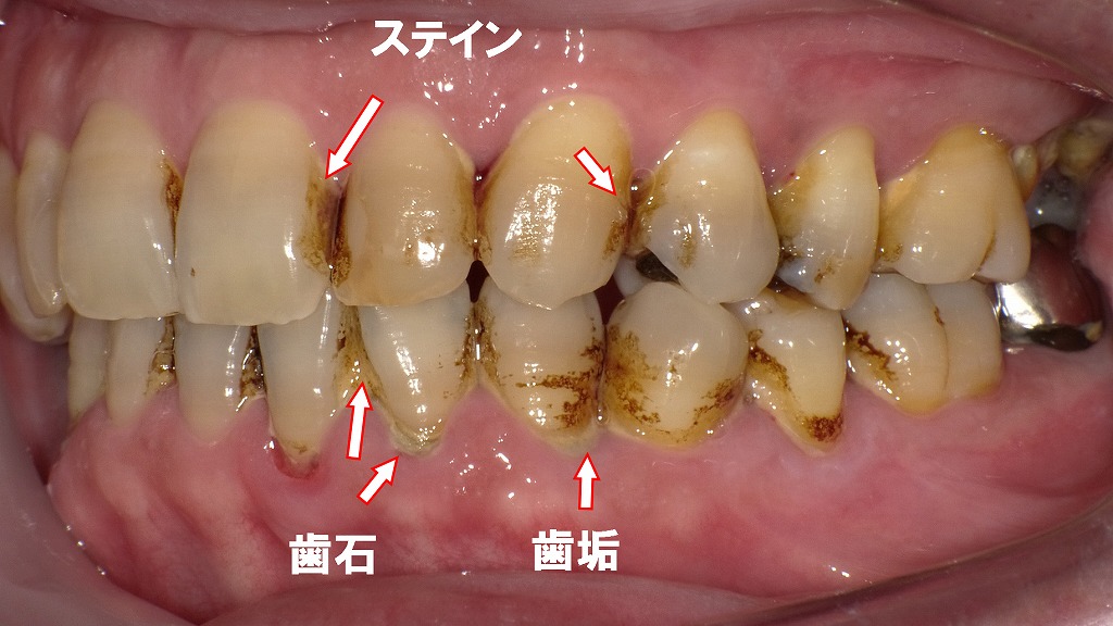 術前：ステイン除去症例