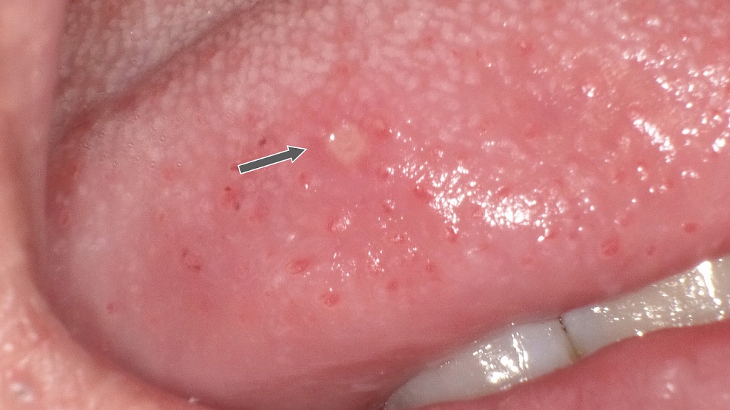 舌にできた口内炎