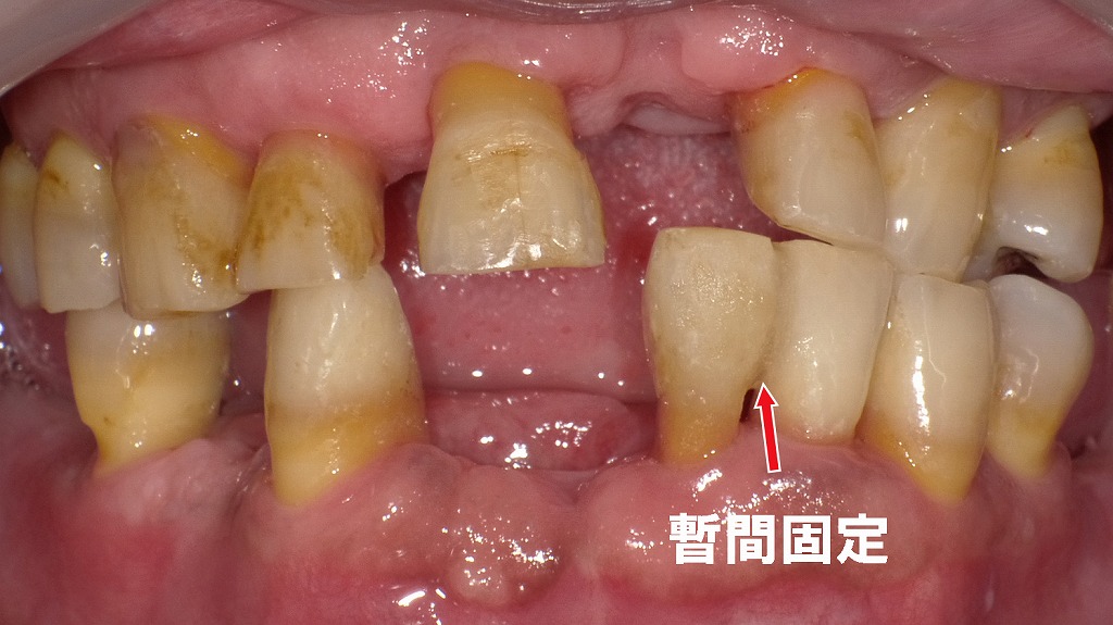 歯石除去後の口腔内。動揺のある左下1・2番は、スーパーボンドで暫間固定し安定化を図っています。