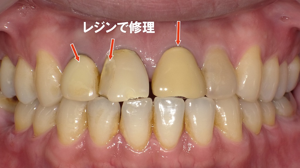 硬質レジン前装冠の経年変化