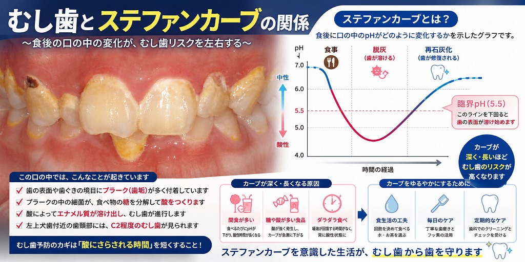 むし歯とステファンカーブの関係