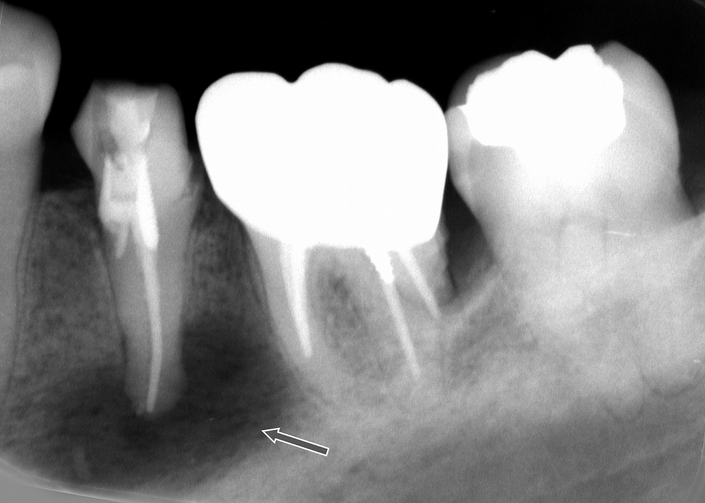 神経を抜いたのに痛い？──原因は“根の先の大きな炎症（根尖病巣）”