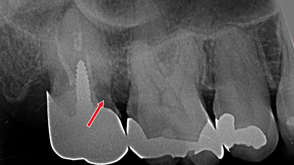 保険診療の金属冠の中に二次カリエス