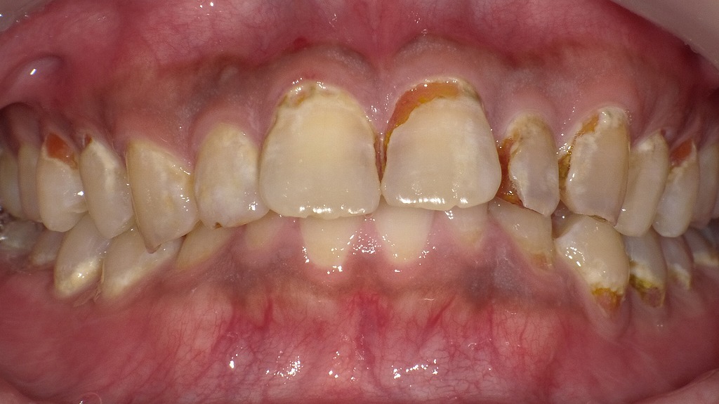 虫歯が進行した歯と口臭の原因となるプラークの例