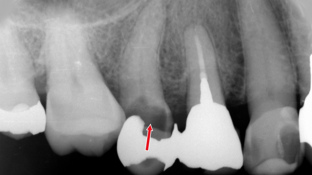 銀歯の下に虫歯（二次カリエス）