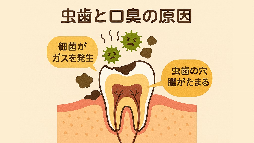 虫歯と口臭の原因
