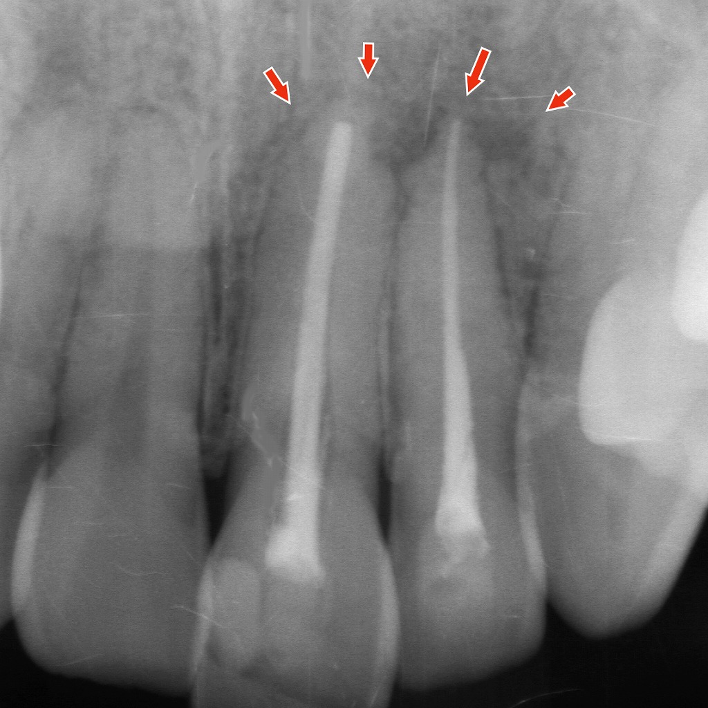 根管治療後6か月の経過：根尖病巣の治癒