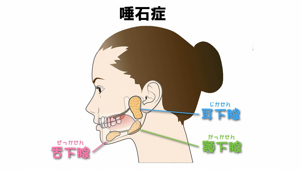 唾石症
