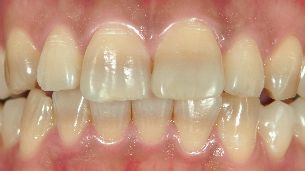 テトラサイクリン歯