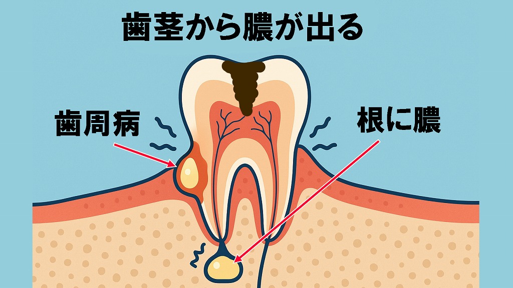 歯茎から膿が出る主な原因