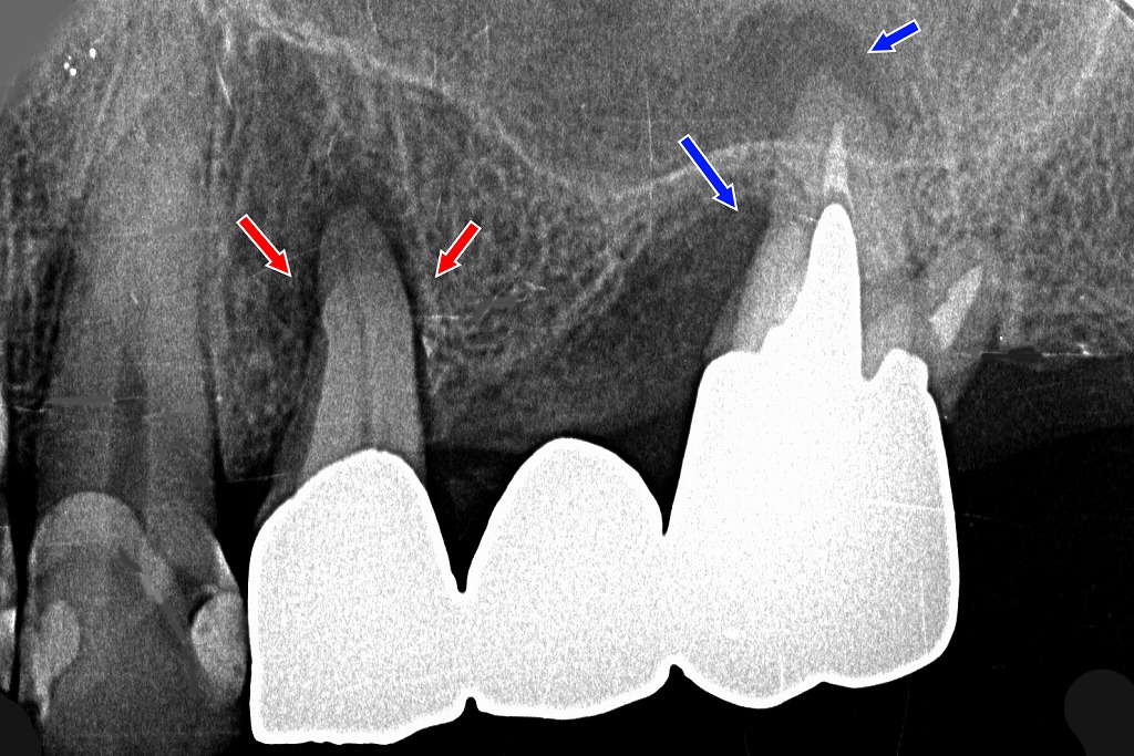 上顎4・5・6番ブリッジに生じた咬合性外傷と支台歯負担過重のレントゲン所見