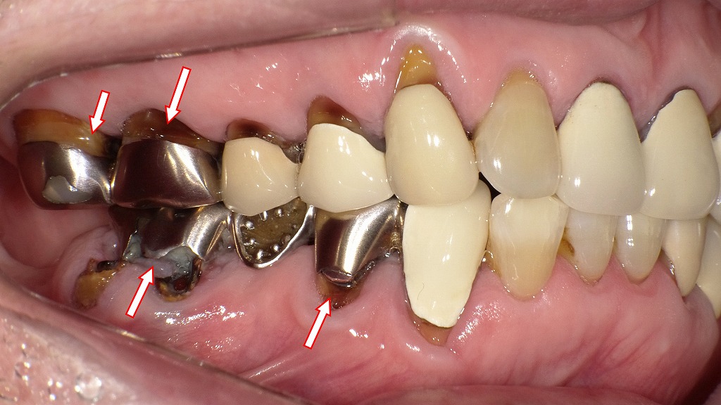 銀歯の不適合が原因と考えられる口臭症例