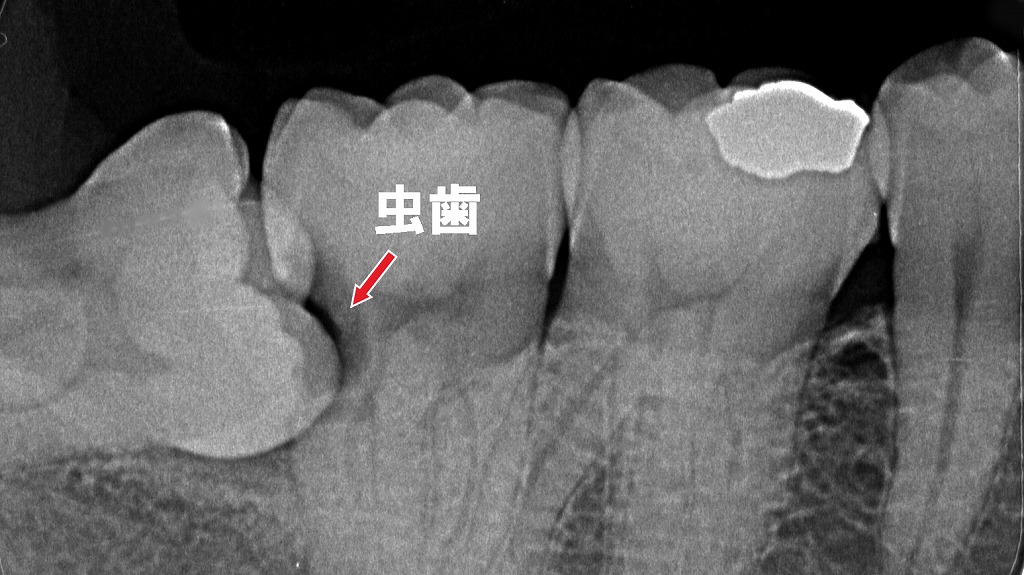 親知らずの炎症と虫歯が、ほほの腫れの大きな原因になります。