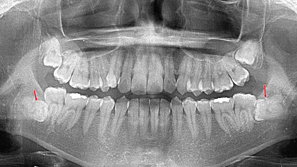 深く埋まった下の親知らずは、舌神経が近く危険があるため慎重な抜歯が必要です。