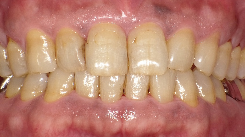 症例2-ステイン（着色汚れ）をエアフローで除去